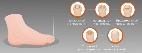 Онихомикоз по месту локализации Онихомикоз по месту локализации