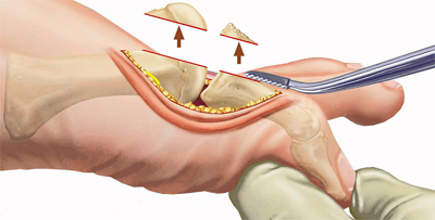 Операция Шеде-Брандеса Операция Шеде-Брандеса