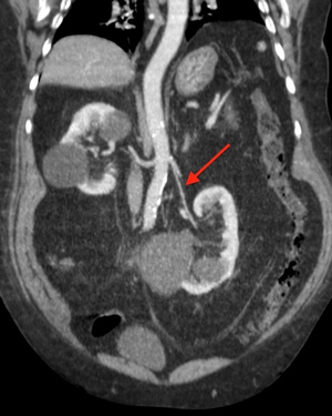 Опущение почки на УЗИ Опущение почки на УЗИ