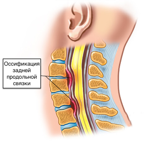 Оссификация задней продольной связки