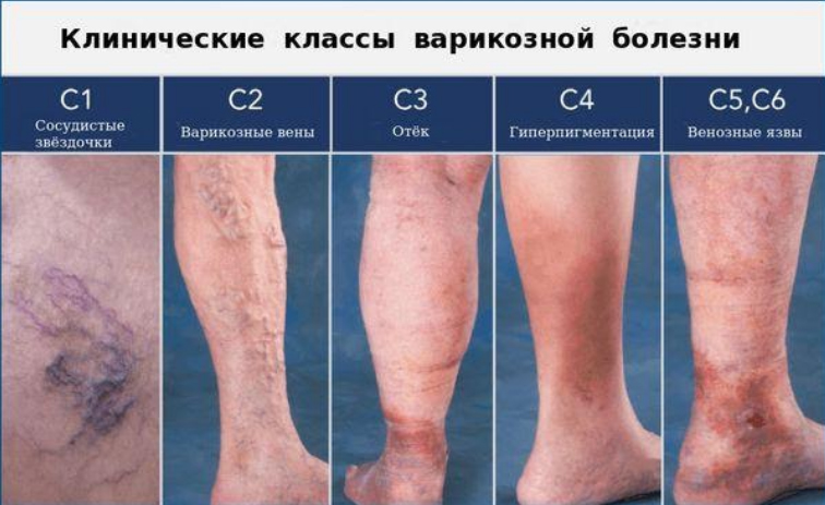 oteki-nog simptomy Отеки ног