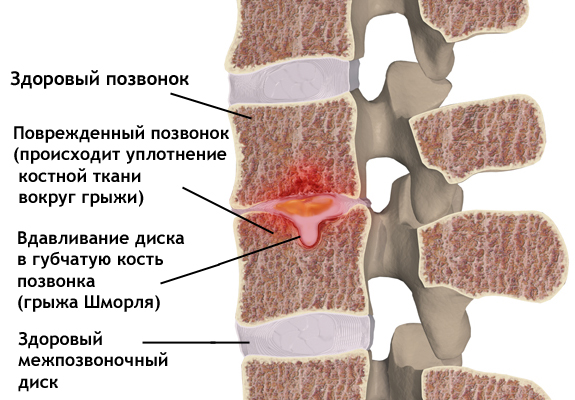 Отличие здорового межпозвоночного диска и со вдавливанием диска - грыжей Шморля Грыжа Шморля