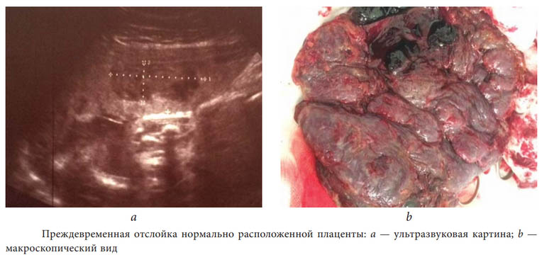 otslojka-placzenty analizy Отслойка плаценты