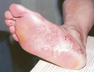 Паховая эпидермофития Паховая эпидермофития