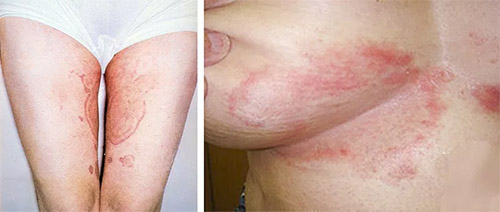 Фото паховой эпидермофитии у женщин Фото паховой эпидермофитии у женщин