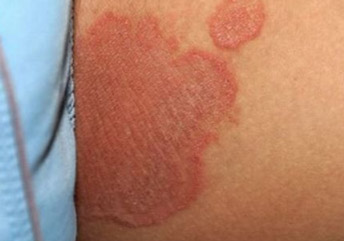 Паховая эпидермофития Паховая эпидермофития