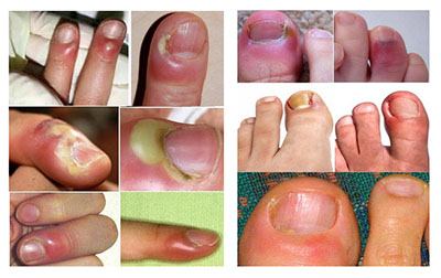 panariczij-paronihiya primery Панариций (паронихия)