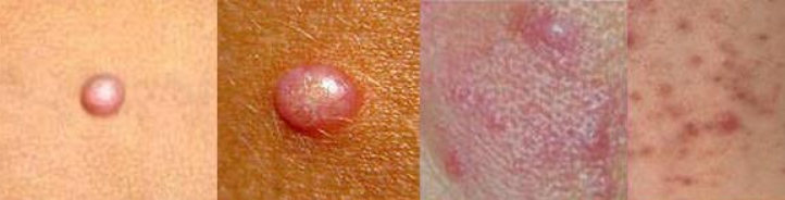 papuly-papulez Папулы (папулез)