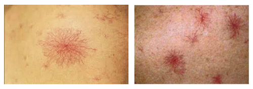 pechenochnaya-nedostatochnost zvezdichky Печеночная недостаточность