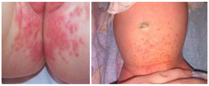 pelenochnyj-dermatit foto Пеленочный дерматит