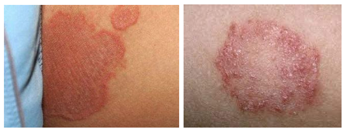 pelenochnyj-dermatit sip Пеленочный дерматит