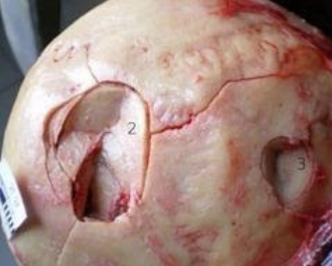 perelom-kostej-cherepa 2 Перелом костей черепа