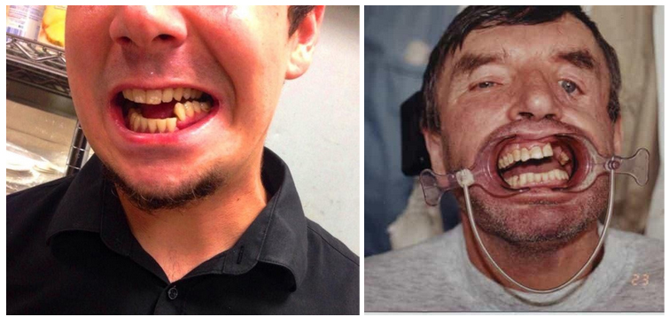 perelom-kostej-cherepa 3 Фото переломов нижней и верхней челюсти