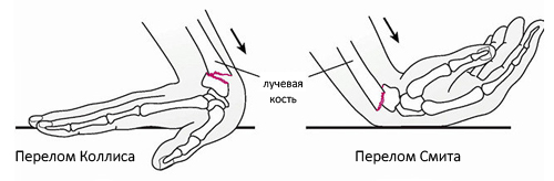 Перелом Коллиса и перелом Смита Перелом Коллиса и перелом Смита