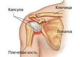 plechelopatochnyj-periartrit 1 Плечелопаточный периартрит