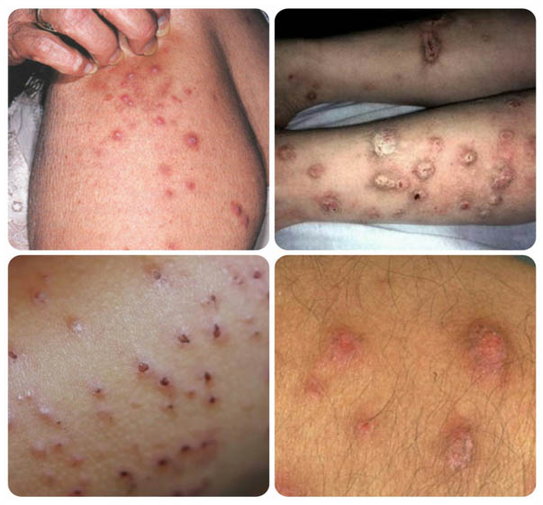 pochesuha-prurigo-strofulyus foto Почесуха (пруриго, строфулюс)