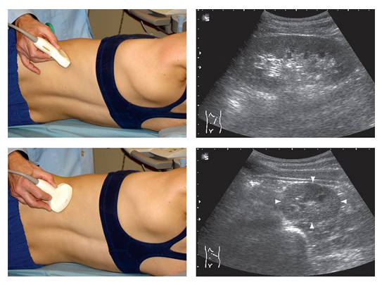 Внешний вид почки на УЗИ Внешний вид почки на УЗИ