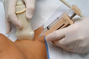 podostryj-tireoi…olezn-de-kervena analizy Бопсия железы