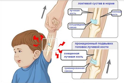 podvyvih-shejnog…podvyvih-atlanta dety Подвывих шейного позвонка (подвывих атланта)