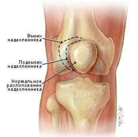podvyvih-shejnog…podvyvih-atlanta kolennogo Подвывих шейного позвонка (подвывих атланта)