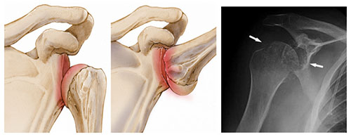 podvyvih-shejnog…podvyvih-atlanta plecho Подвывих шейного позвонка (подвывих атланта)