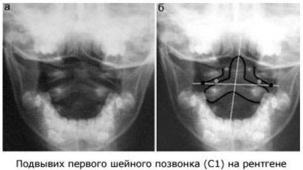podvyvih-shejnog…podvyvih-atlanta rentgen Подвывих шейного позвонка (подвывих атланта)