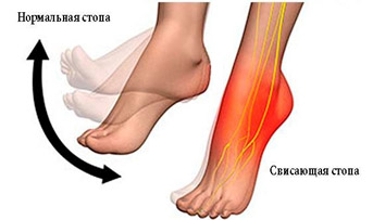 polinejropatiya svisaushaya Полинейропатия
