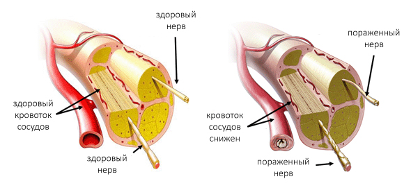 Кровоток и нервы у здорового человека и при полинейропатии Кровоток и нервы у здорового человека и при полинейропатии