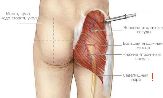 Правильная локализация места укола в ягодицы