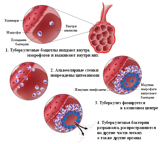 Процесс образования туберкулеза Процесс образования туберкулеза