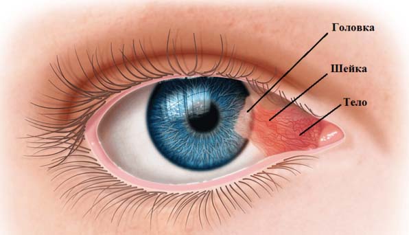 pterigium-glaza 1 Птеригиум глаза