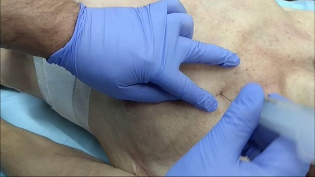 Плевральная пункция Плевральная пункция