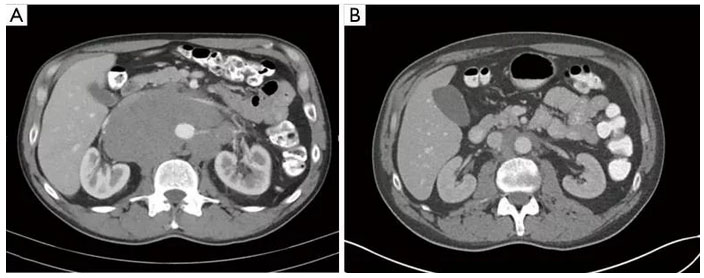 rak-yaichek 2 Рак яичек