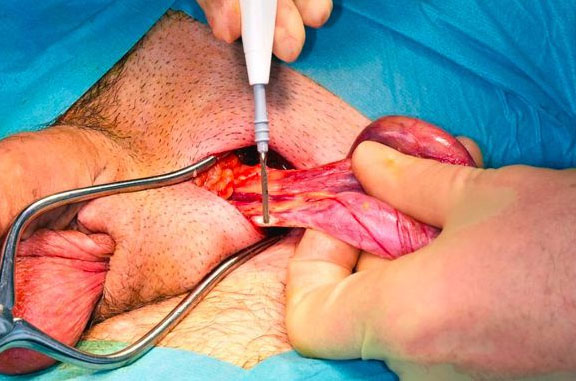 rak-yaichek 5 Рак яичек