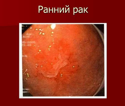 rak-zheludka analizy2 Рак желудка