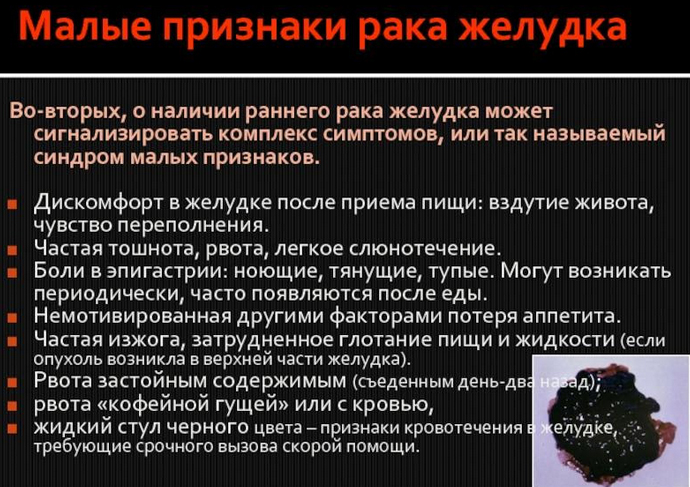 rak-zheludka priznaky Рак желудка