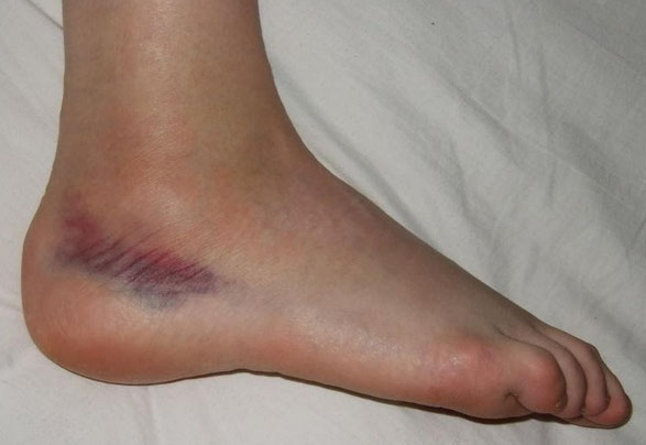 razryv-svyazok golenostop Разрыв связок