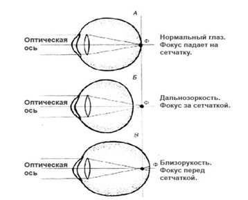 Схематическое объяснение нарушения рефракции глаза Схематическое объяснение нарушения рефракции глаза