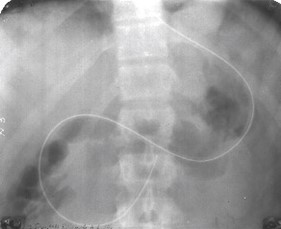 Изгиб зонда при выходе из желудка в области верхнего отдела двенадцатиперстной кишки Изгиб зонда при выходе из желудка в области верхнего отдела двенадцатиперстной кишки