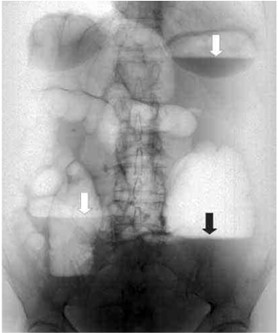 Обзорный снимок брюшной полости. Чаши клойбера на рентгенограмме, характерные для толстокишечной непроходимости Обзорный снимок брюшной полости. Чаши клойбера на рентгенограмме, характерные для толстокишечной непроходимости