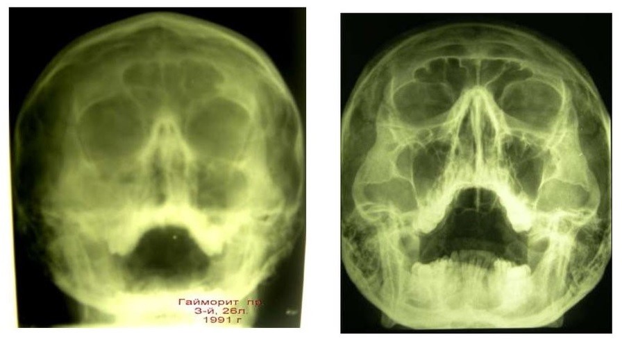 Сравнение аналоговой и цифровой рентгенографии Сравнение аналоговой и цифровой рентгенографии