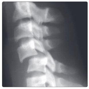 Рентгенограмма шейного отдела в боковой проекции. Двусторонний сцепившийся вывих С4-С5 Рентгенограмма шейного отдела в боковой проекции. Двусторонний сцепившийся вывих С4-С5