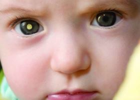 Симптомы ретинобластомы глаза Симптомы ретинобластомы глаза