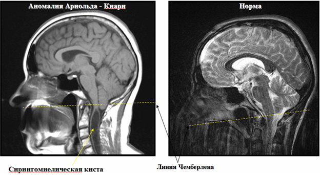 Результаты МРТ при аномалии Арнольда Киари с сирингомиелической кистой и в норме