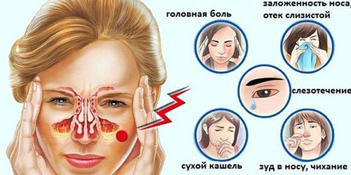 rinit-2 simptomy Ринит