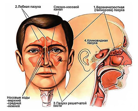 Риносинусит Риносинусит