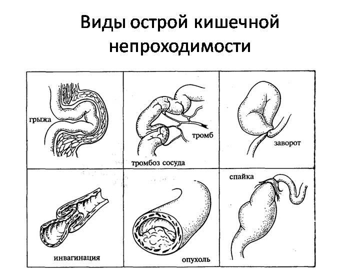 Виды острой кишечной непроходимости Виды острой кишечной непроходимости