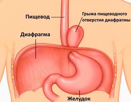 Ущемление грыжи пищеводного отверстия диафрагмы Ущемление грыжи пищеводного отверстия диафрагмы