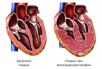 Сердце при миокардиодистрофии в разрезе Сердце при миокардиодистрофии в разрезе