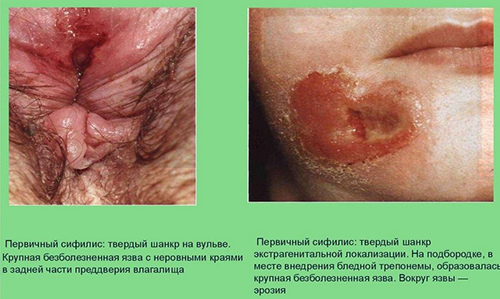 shankr foto Шанкр